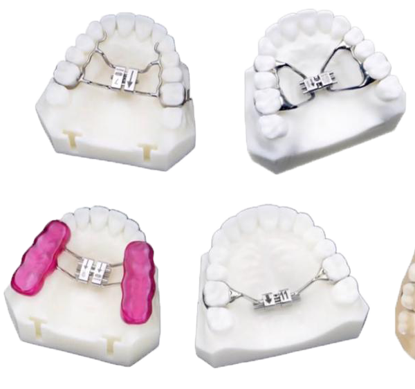 Rapid Palatal Expansion